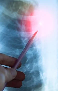 Vertical image of a Fluorography, X-ray. Human lung cancer. Medical treatme.. Stock Photos