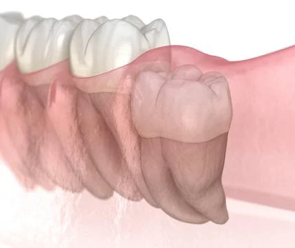 Vertical impaction of Wisdom tooth. Medically accurate tooth 3D illustration Stock Illustration