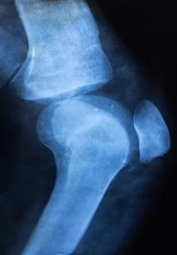 Vertical Knee joint x-ray. Diagnostic of Knee bone pathology, detected, suc.. 스톡 사진