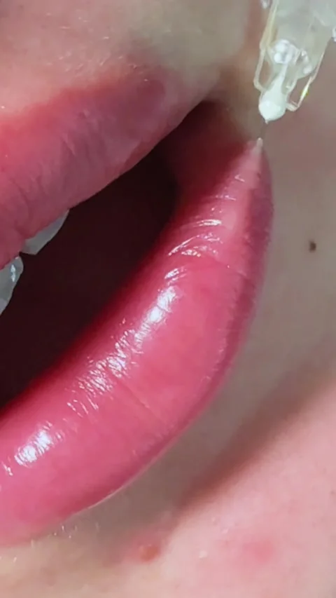 Vertical Macro Lower Lip Corner Filler Injection Closeup Stock Footage 317557479