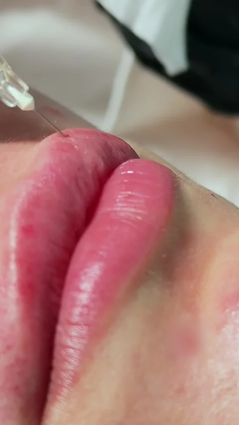 Vertical Macro Upper Lip Filler Injection Needle Close Stock Footage 317557547