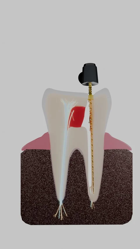 Vertical molar cross section showing root canal procedure and, Vertical 9:16 4K Stock Footage 346121460