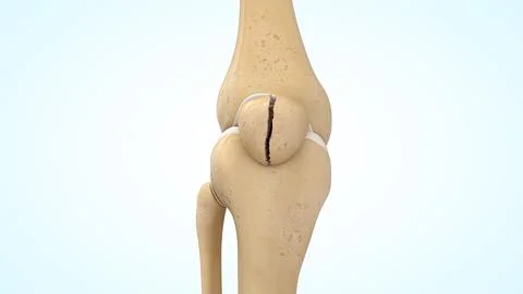 Vertical patella bone fracture of 3d illustration Stock Illustration