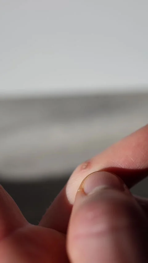 Vertical screen: A close-up of a human finger with a small skin wart. The natura Stock Footage 304622986