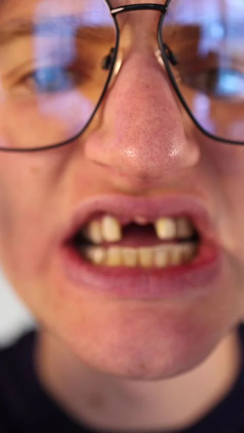 Vertical screen closeup of decayed teeth young man grimaces while holding soda a Stock Footage 312195694