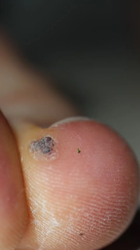 Vertical screen closeup of a dried wart on a toe shows flaking skin and healing  Stock Footage 313063344