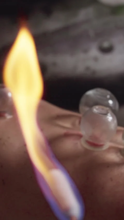 Vertical Screen: Therapist Heating Suction Cups Using Fire Cupping Stick and Stock Footage 287995296