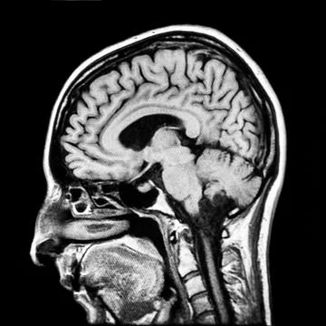 Vertical section of human brain MRI scan Stock Photos