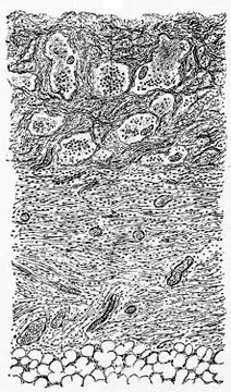 Vertical section through an inflamed serous membrane after the formation of f Stock Illustration
