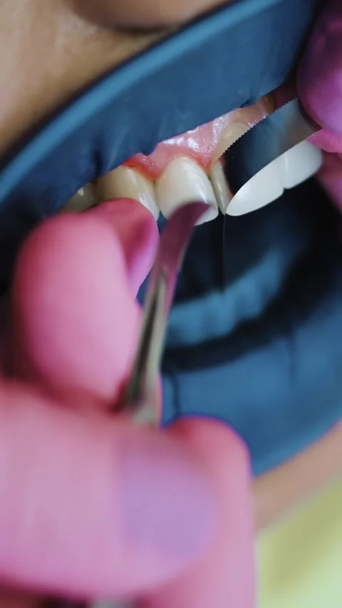 Vertical shot of a dentist removing excess composite from dental veneer Stock Footage 342239808