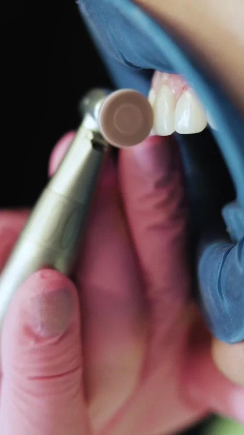 Vertical side view of dentist polishing patient teeth with tool Stock Footage 342239749