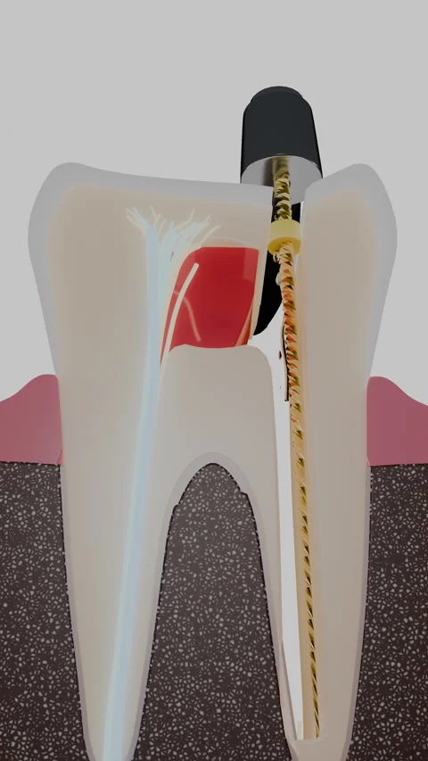 Vertical tooth cross section showing root canal therapy and, Vertical 9:16 4K Stock Footage 346121407