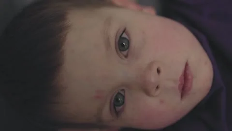 Vertical video child boy with red spots of chickenpox discomfort of illness Stock Footage 268341445