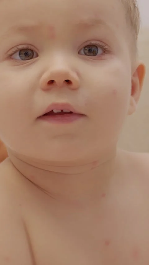 Vertical video Child with early stage chickenpox showing itching on skin Stock Footage 334030509