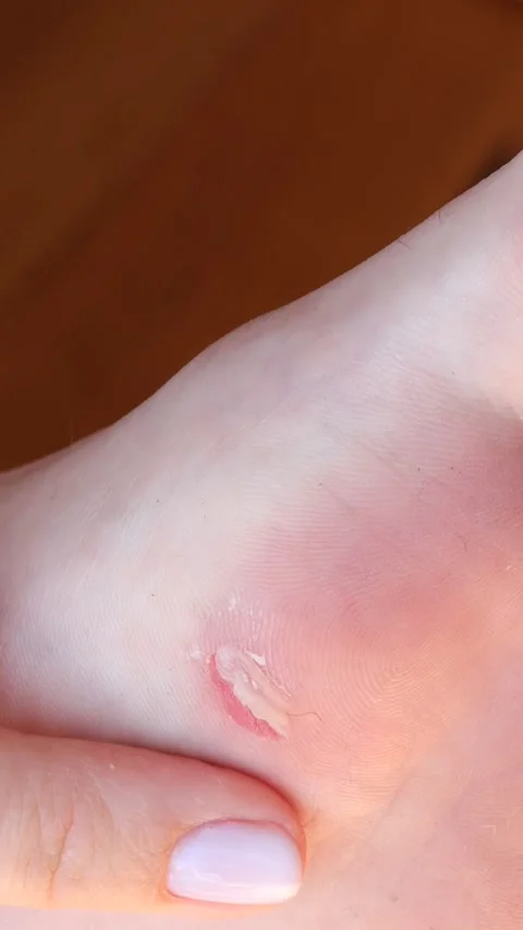Vertical video closeup of foot with visible callus under big toe gently touched Stock Footage 311327780