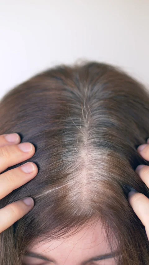 Vertical video. Closeup view of gray hair appearing along part line, with gray Stock Footage 322617702
