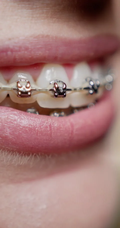 Vertical video. Dental Braces. Close up smile of woman with dental braces Stock Footage 281577812