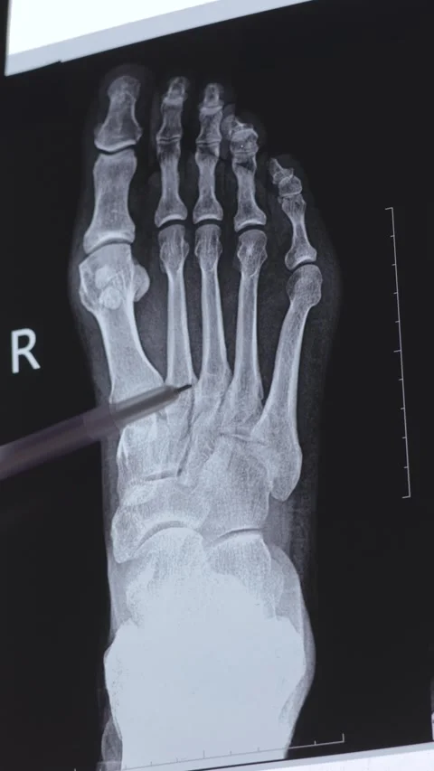 Vertical video of a Doctor learning X-ray of foot fingers Stock Footage 294194442