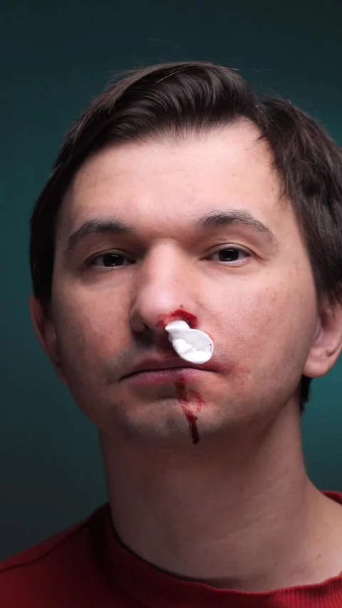 Vertical video Man suffering nosebleed holding tissue against nostril Stock Footage 304738567