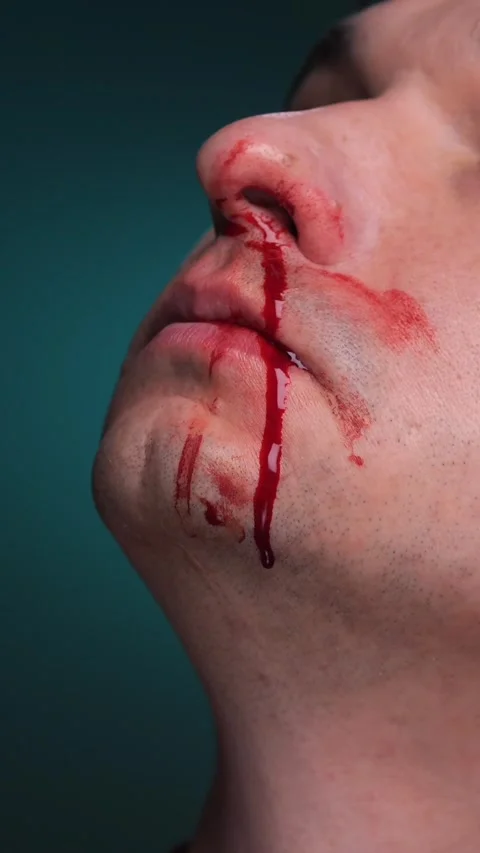 Vertical video Man suffering nosebleed with blood dripping on chin Stock Footage 304738570