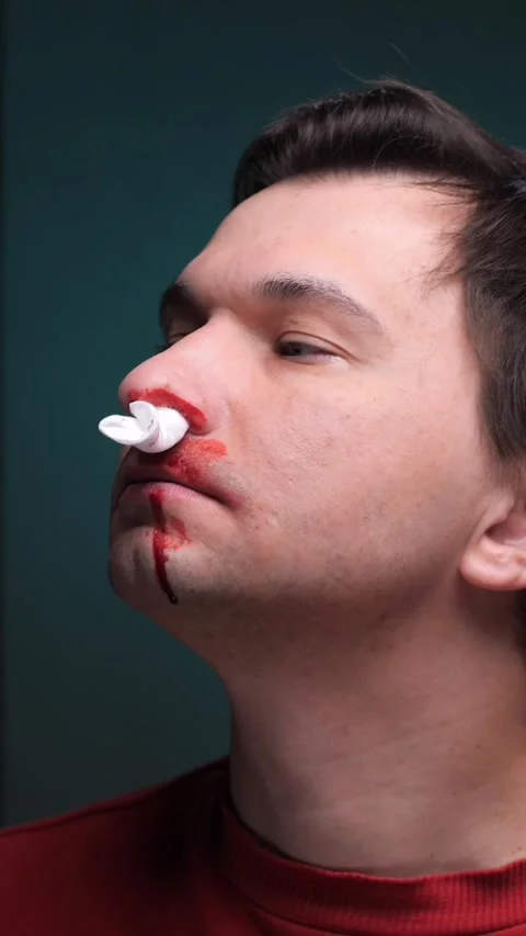 Vertical video Man suffering from nosebleed holding tissue against nostril Stock Footage 304738573