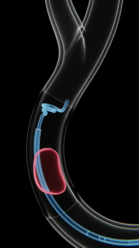 Vertical video of Mechanical Thrombectomy (Clot removing) process in 4K | Stock Footage 331606352