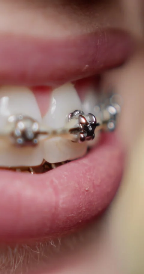 Vertical video. Metal brackets on teeth and importance of maintaining oral care Stock Footage 281578434
