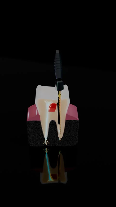 Vertical view of endodontic file cleaning infected molar root, Vertical 9:16 4K Stock Footage 346120734