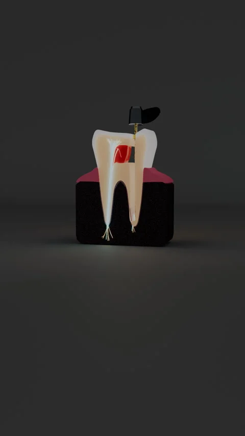 Vertical view of rotary file cleaning root canal in tooth, Vertical 9:16 4K Stock Footage 346121520