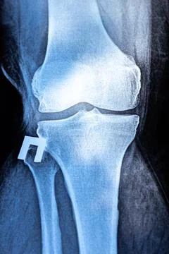 Vertical X-ray of Knee joint dislocation after accident. Patellar joint ins.. Stock Photos