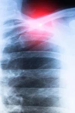 Vertical X-ray scan of  Dislocation of the acromial end of the clavicle. Stock Photos