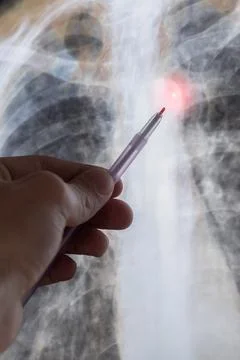 Vertical X-ray scan of Human bones disease. Spine cancer. Doctor learn diag.. 스톡 사진