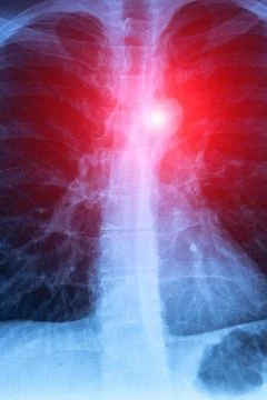 Vertical X-ray scan of a tuberculosis and lungs diseases. Stock Photos