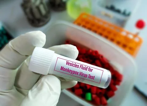Vesicles fluid sample for Monkeypox virus test. 스톡 사진