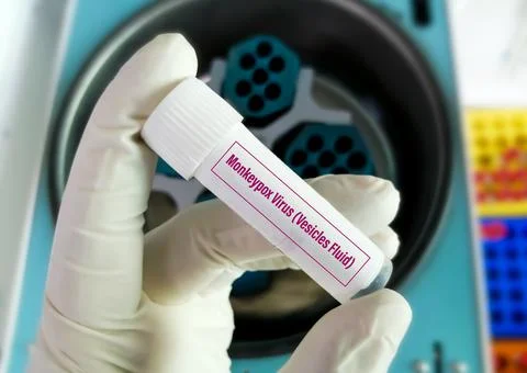 Vesicles fluid sample for Monkeypox virus test. 스톡 사진