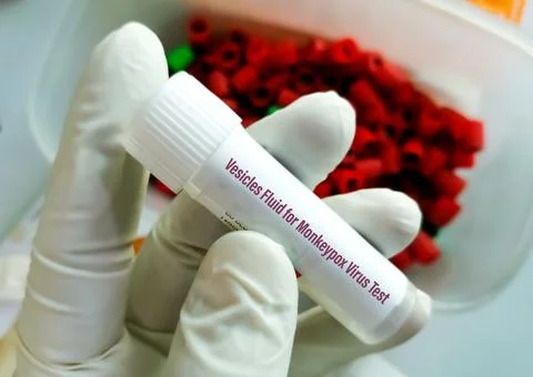 Vesicles fluid sample for Monkeypox virus test. Foto stock