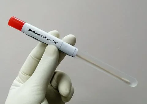Vesicles fluid sample for Monkeypox virus test. 스톡 사진