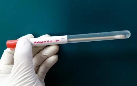 Vesicles fluid sample for Monkeypox virus test. 스톡 사진