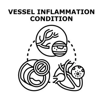 Vessel inflammation condition causing cardiovascular problems Stock Illustration