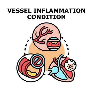 Vessel inflammation condition causing cardiovascular problems Stock Illustration