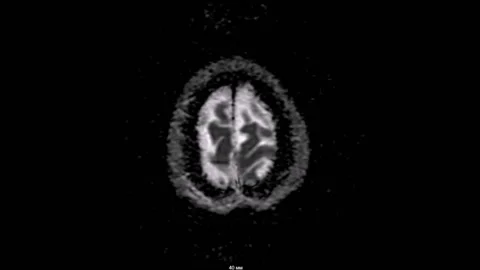 Vessels of the brain MR SR MRI tomography Vídeo Stock 196876735