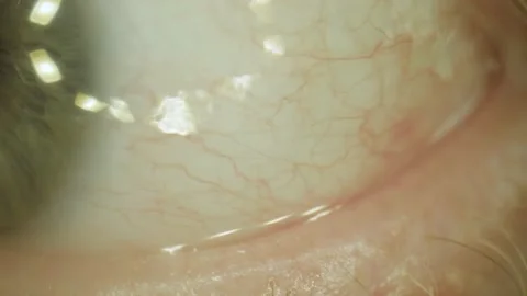 Vessels on the eyeball Stock Footage 170069537