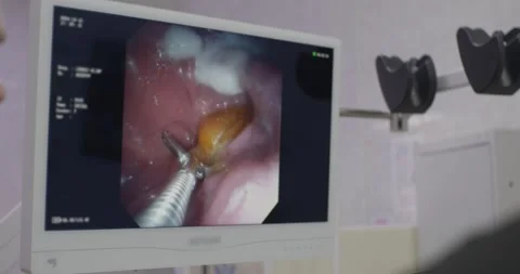 A veterinarian performs an endoscopic procedure, carefully removing a foreign Stock Footage 308016339