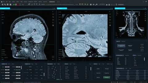 VFX Medical MRI Software Interface With Human Brain Stock Footage 243809298