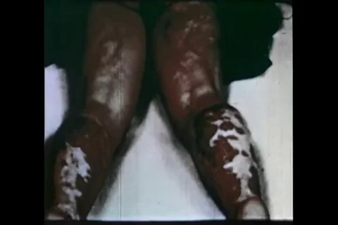 Victim affected by atomic bomb radiation - 1949 Stock Footage 103594530