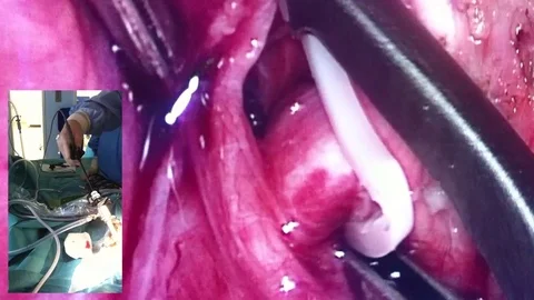 Video broadcast of endoscopic operation Stock Footage 74215285