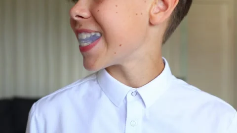 The video captures a close-up of him placing the aligner into his mouth Video stock 287456524