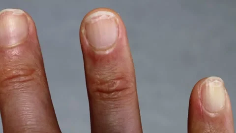 Video of a hand with cracked fingernails Stock Footage 324549069