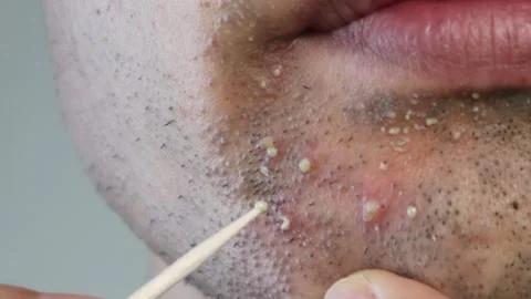 Video of a Japanese man squeezing pus from his face Stock Footage 326083596