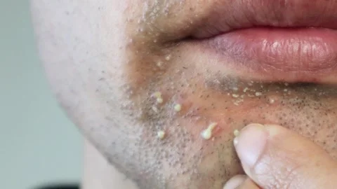 Video of a Japanese man squeezing pus from his face Stock Footage 326087119